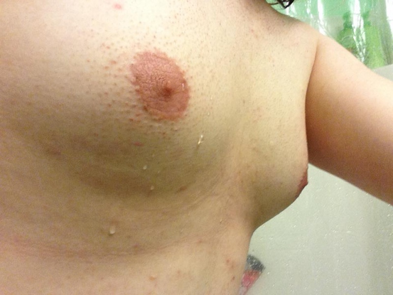 File:D-Cup Manboobs.jpg